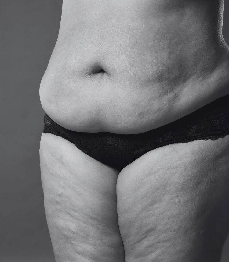 Image comparing mild and severe cellulite grades Sandwich