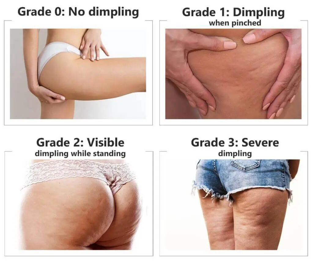 Representation of the stages of cellulite development Sandwich